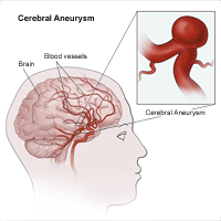 Cerebral Aneurysm